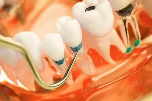 国产牙冠如何辨真伪视频